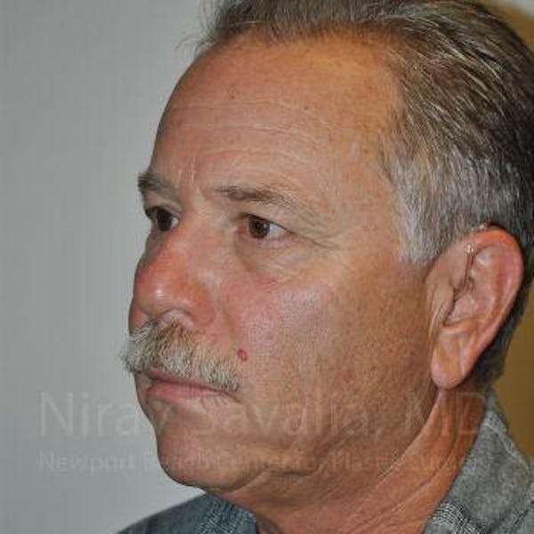 Eyelid Surgery Before & After Gallery - Patient 1655711 - Image 7