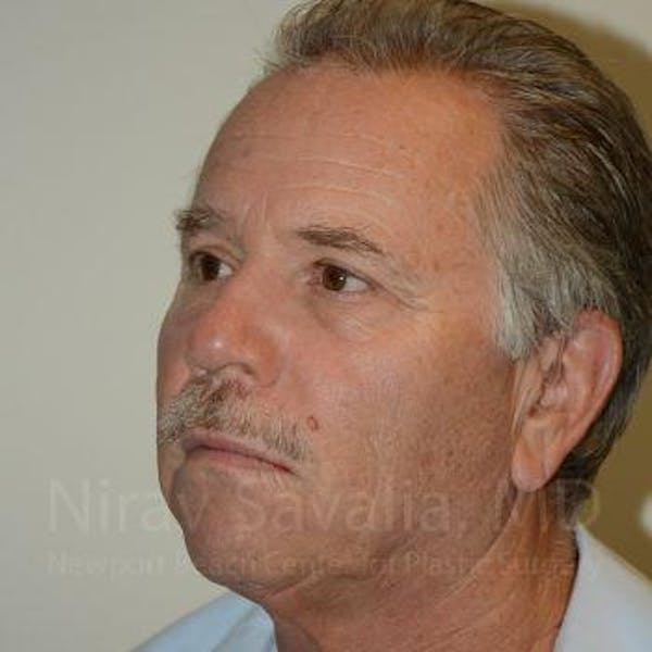Eyelid Surgery Before & After Gallery - Patient 1655711 - Image 8