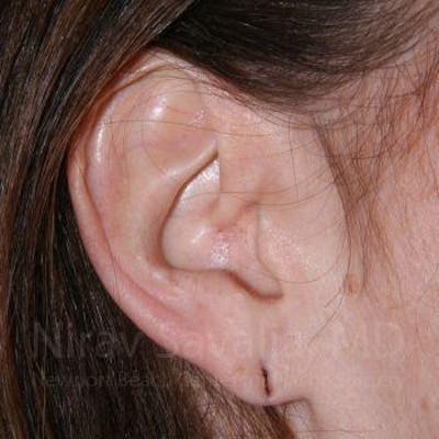 Torn Earlobe Repair / Ear Gauge Repair Before & After Gallery - Patient 1655713 - Image 1