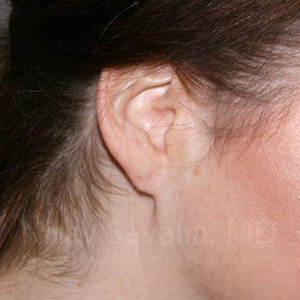 Torn Earlobe Repair / Ear Gauge Repair Before & After Gallery - Patient 1655713 - Image 2