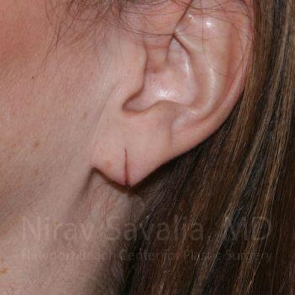 Torn Earlobe Repair / Ear Gauge Repair Before & After Gallery - Patient 1655713 - Image 3