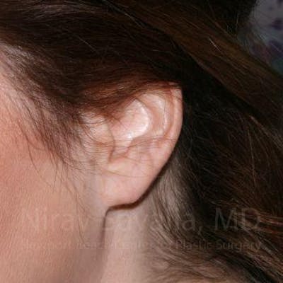 Torn Earlobe Repair / Ear Gauge Repair Before & After Gallery - Patient 1655713 - Image 4