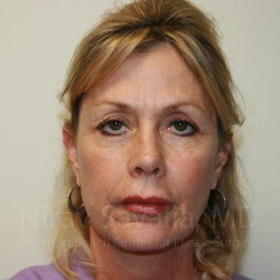 Eyelid Surgery Before & After Gallery - Patient 1655714 - Image 1