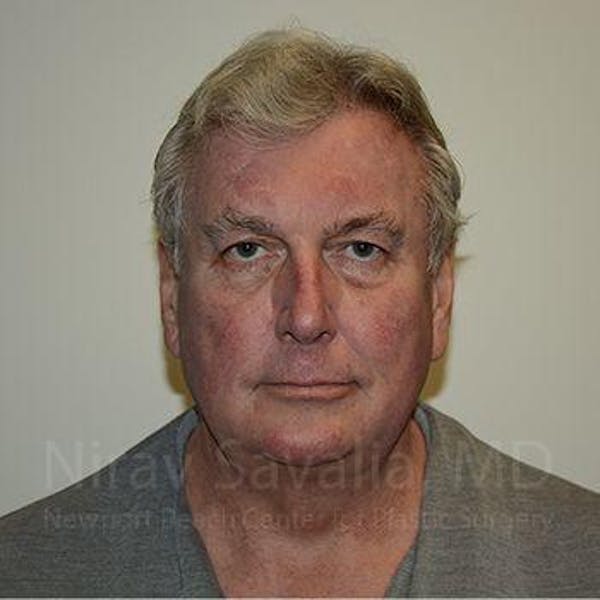 Facelift Before & After Gallery - Patient 1655717 - Image 3