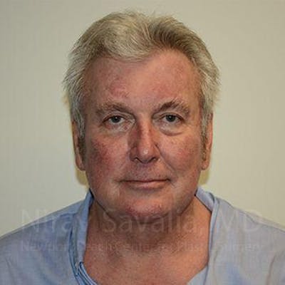Facelift Before & After Gallery - Patient 1655717 - Image 4