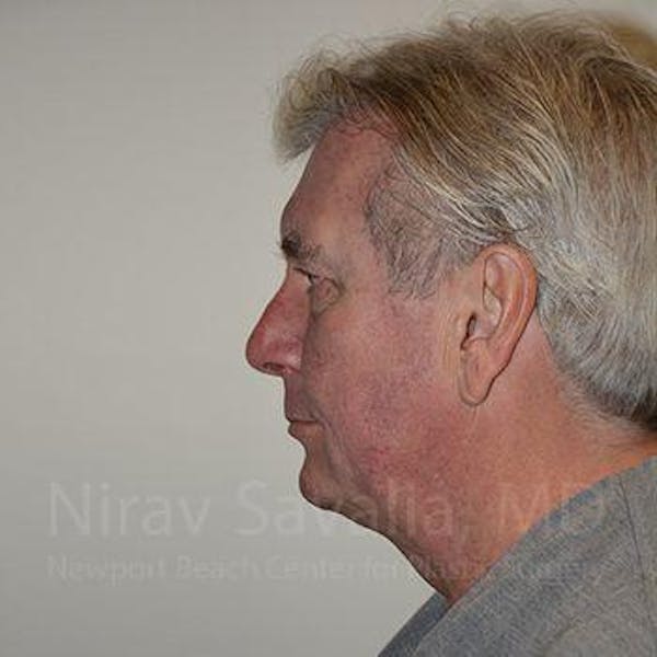 Facelift Before & After Gallery - Patient 1655717 - Image 5