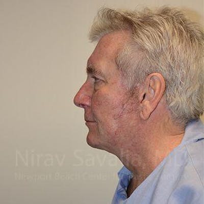 Facelift Before & After Gallery - Patient 1655717 - Image 6