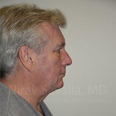 Facelift Before & After Gallery - Patient 1655717 - Image 1