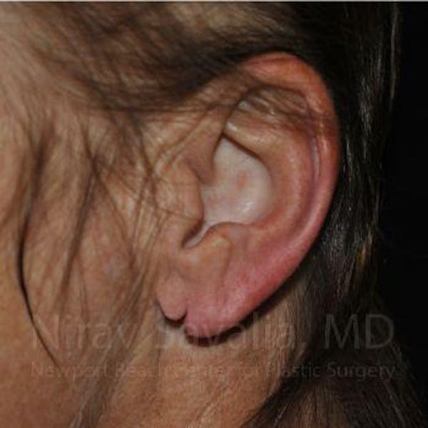 Torn Earlobe Repair / Ear Gauge Repair Before & After Gallery - Patient 1655715 - Image 1