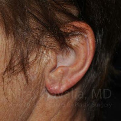Torn Earlobe Repair / Ear Gauge Repair Before & After Gallery - Patient 1655715 - Image 2