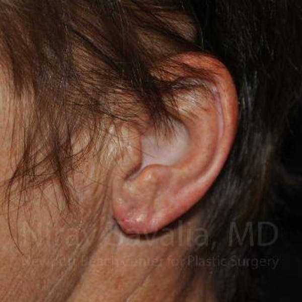 Torn Earlobe Repair / Ear Gauge Repair Before & After Gallery - Patient 1655715 - Image 2