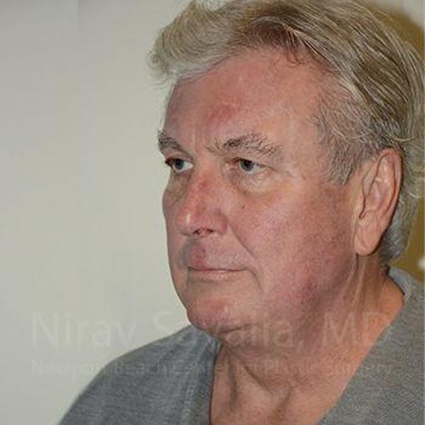 Facelift Before & After Gallery - Patient 1655717 - Image 7