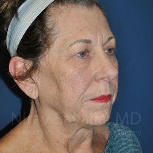 Fat Grafting to Face Before & After Gallery - Patient 1655716 - Image 9