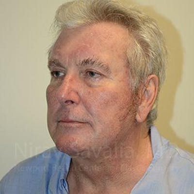Facelift Before & After Gallery - Patient 1655717 - Image 8