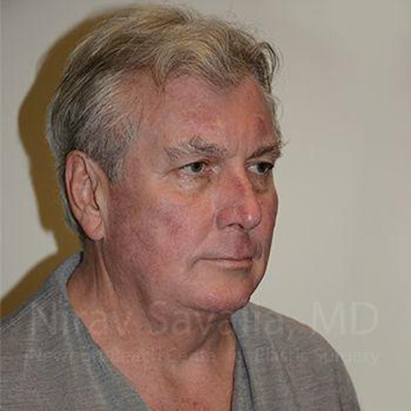 Facelift Before & After Gallery - Patient 1655717 - Image 9