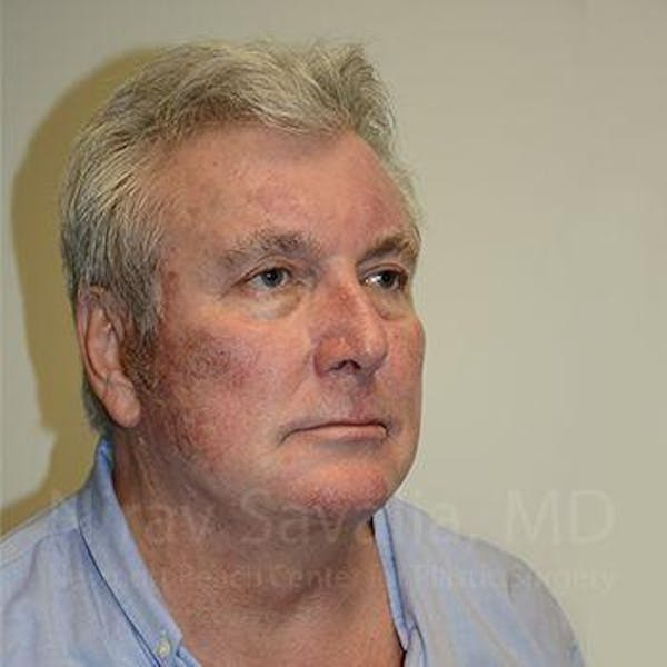 Facelift Before & After Gallery - Patient 1655717 - Image 10