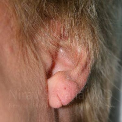 Torn Earlobe Repair / Ear Gauge Repair Before & After Gallery - Patient 1655718 - Image 1