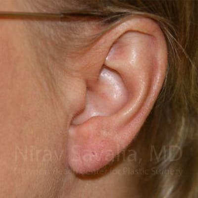 Torn Earlobe Repair / Ear Gauge Repair Before & After Gallery - Patient 1655718 - Image 2