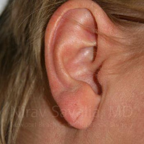 Torn Earlobe Repair / Ear Gauge Repair Before & After Gallery - Patient 1655718 - Image 3