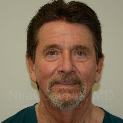 Fat Grafting to Face Before & After Gallery - Patient 1655720 - Image 1