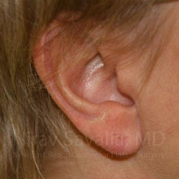 Torn Earlobe Repair / Ear Gauge Repair Before & After Gallery - Patient 1655718 - Image 4