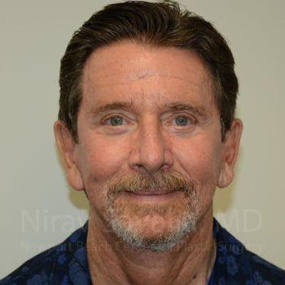 Fat Grafting to Face Before & After Gallery - Patient 1655720 - Image 2