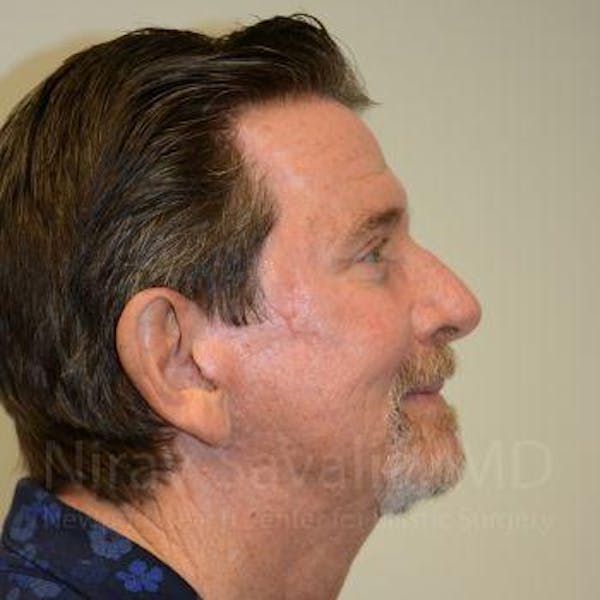 Fat Grafting to Face Before & After Gallery - Patient 1655720 - Image 4