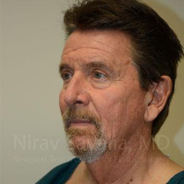 Fat Grafting to Face Before & After Gallery - Patient 1655720 - Image 7