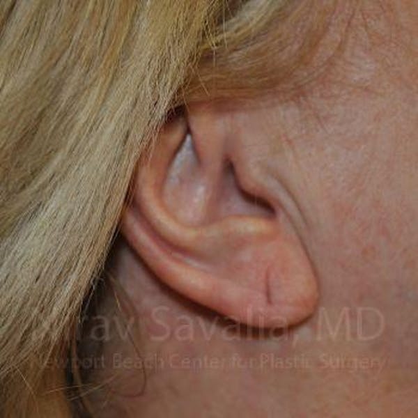 Torn Earlobe Repair / Ear Gauge Repair Before & After Gallery - Patient 1655722 - Image 1