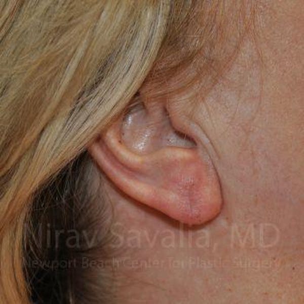 Torn Earlobe Repair / Ear Gauge Repair Before & After Gallery - Patient 1655722 - Image 2