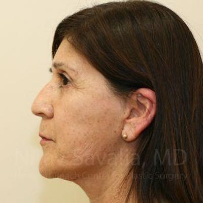 Facelift Before & After Gallery - Patient 1655721 - Image 8