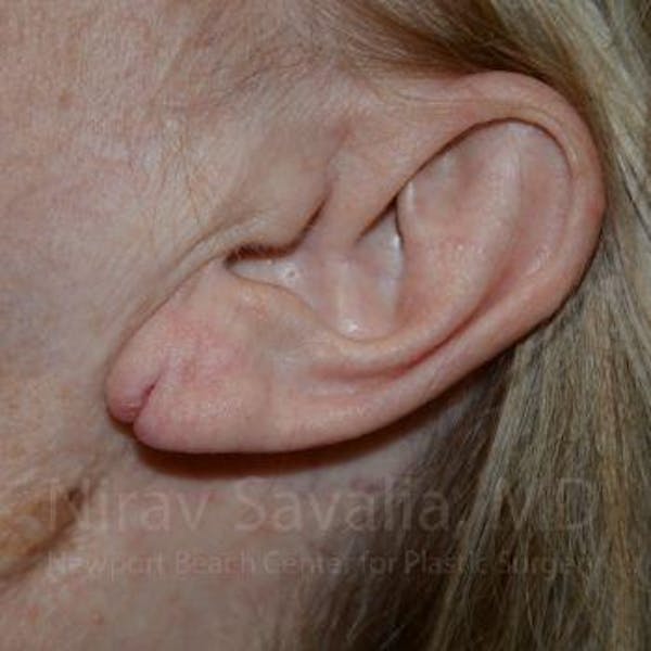 Torn Earlobe Repair / Ear Gauge Repair Before & After Gallery - Patient 1655722 - Image 3