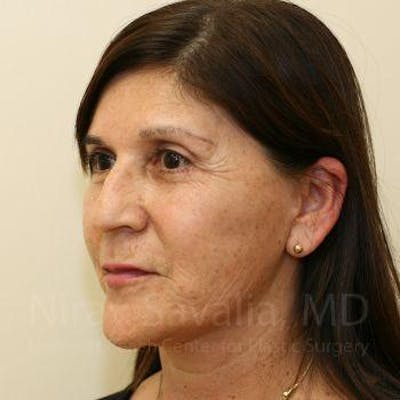 Facelift Before & After Gallery - Patient 1655721 - Image 10