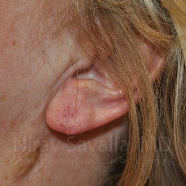 Torn Earlobe Repair / Ear Gauge Repair Before & After Gallery - Patient 1655722 - Image 4