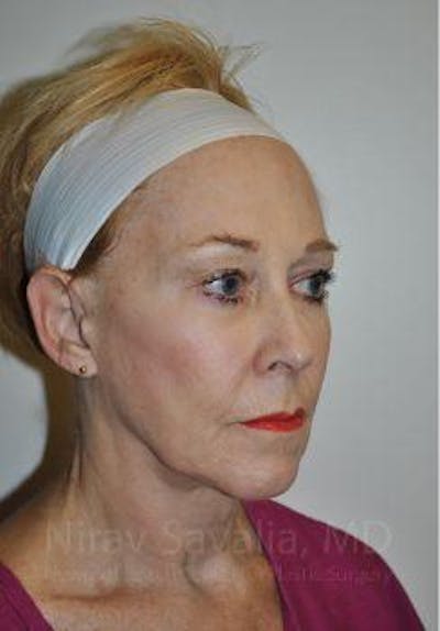 Fat Grafting to Face Before & After Gallery - Patient 1655725 - Image 1