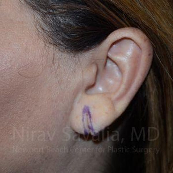Torn Earlobe Repair / Ear Gauge Repair Before & After Gallery - Patient 1655724 - Image 1