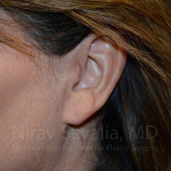 Torn Earlobe Repair / Ear Gauge Repair Before & After Gallery - Patient 1655724 - Image 2