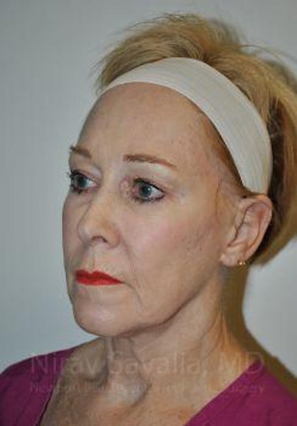Fat Grafting to Face Before & After Gallery - Patient 1655725 - Image 3