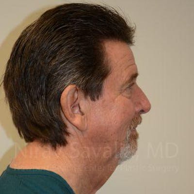 Facelift Before & After Gallery - Patient 1655726 - Image 1