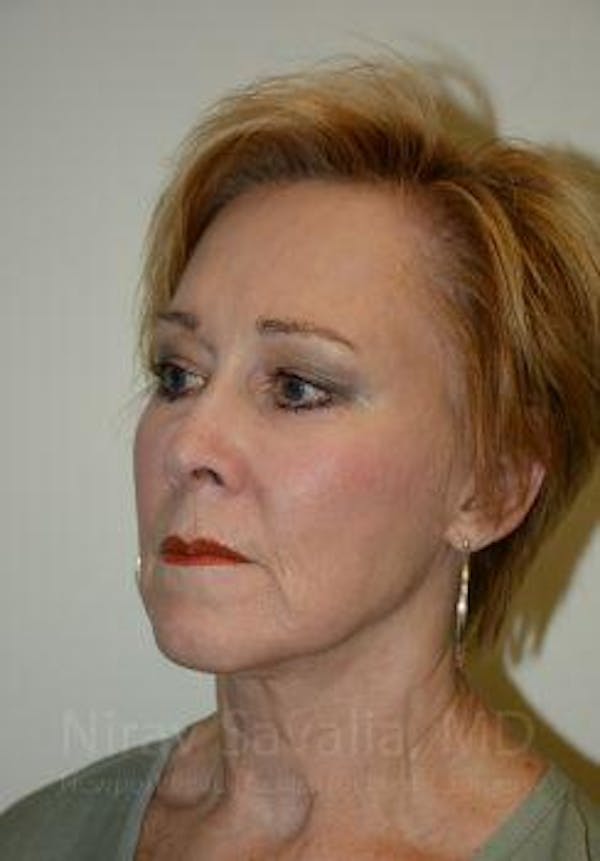 Fat Grafting to Face Before & After Gallery - Patient 1655725 - Image 4