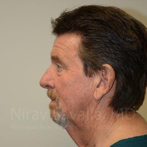 Facelift Before & After Gallery - Patient 1655726 - Image 5
