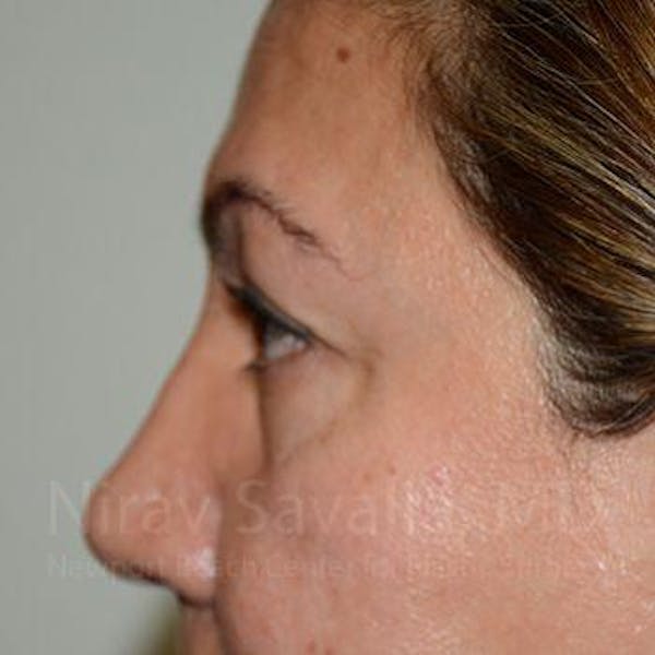 Eyelid Surgery Before & After Gallery - Patient 1655728 - Image 3