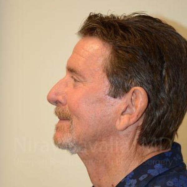 Facelift Before & After Gallery - Patient 1655726 - Image 6