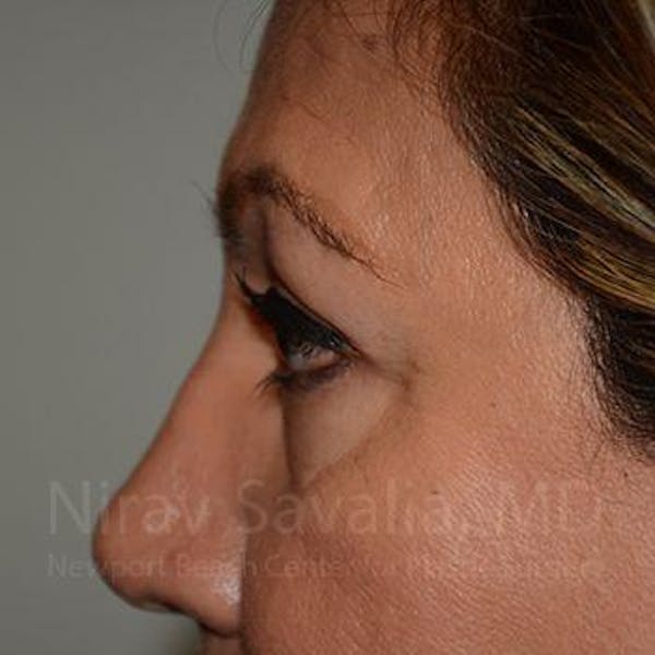 Eyelid Surgery Before & After Gallery - Patient 1655728 - Image 4