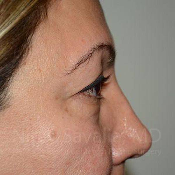 Eyelid Surgery Before & After Gallery - Patient 1655728 - Image 5