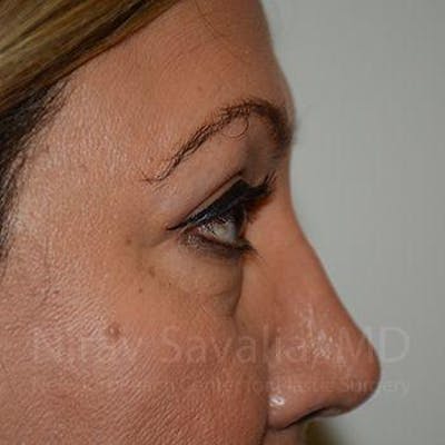 Eyelid Surgery Before & After Gallery - Patient 1655728 - Image 6