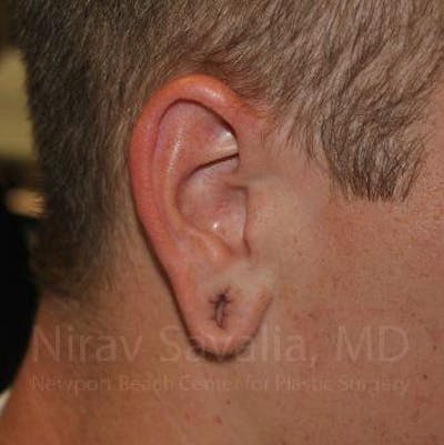 Torn Earlobe Repair / Ear Gauge Repair Before & After Gallery - Patient 1655727 - Image 1