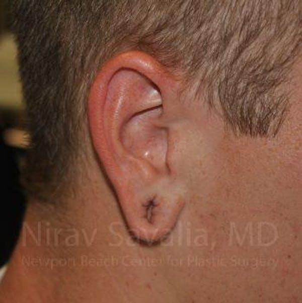 Torn Earlobe Repair / Ear Gauge Repair Before & After Gallery - Patient 1655727 - Image 1