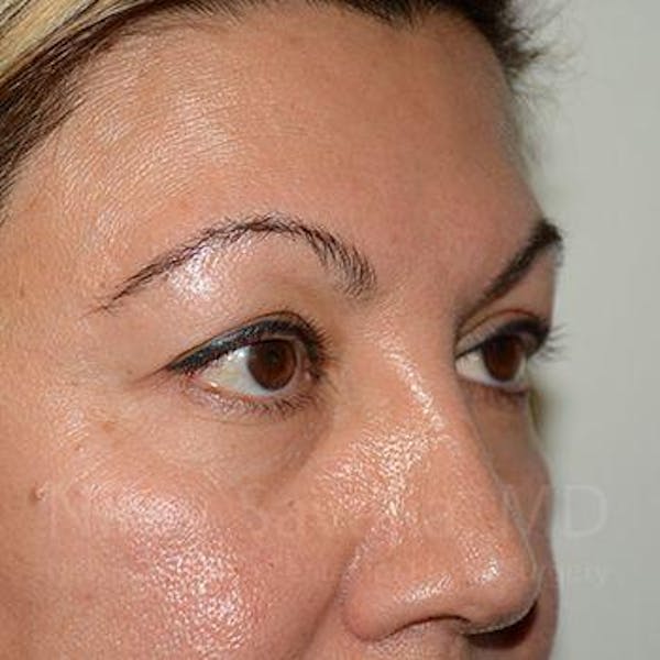 Eyelid Surgery Before & After Gallery - Patient 1655728 - Image 7