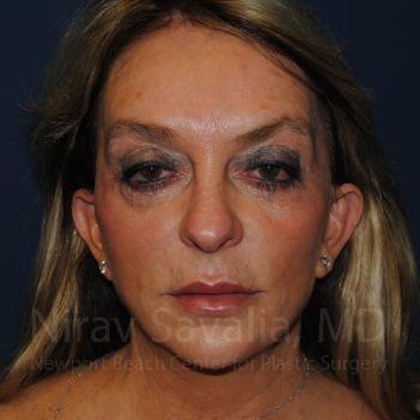 Fat Grafting to Face Gallery - Patient 1655730 - Image 1